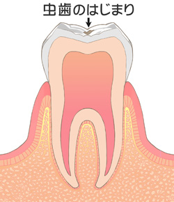 初期のむし歯