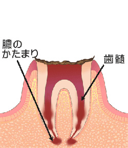 神経にまで達したむし歯