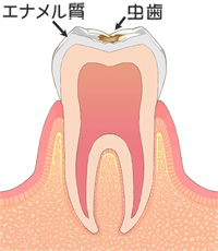 C1 【エナメル質のむし歯】