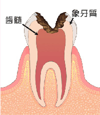 C3 【神経まで達したむし歯】