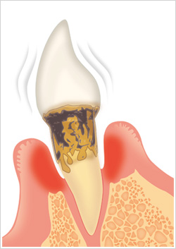 歯周病経過2
