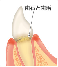 歯肉炎