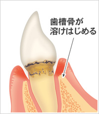 初期歯肉炎